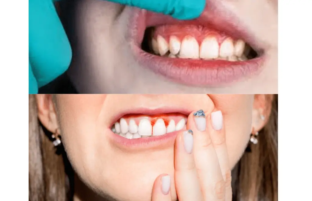 Cut On Gums Causes Treatment And Prevention Oral Health Line