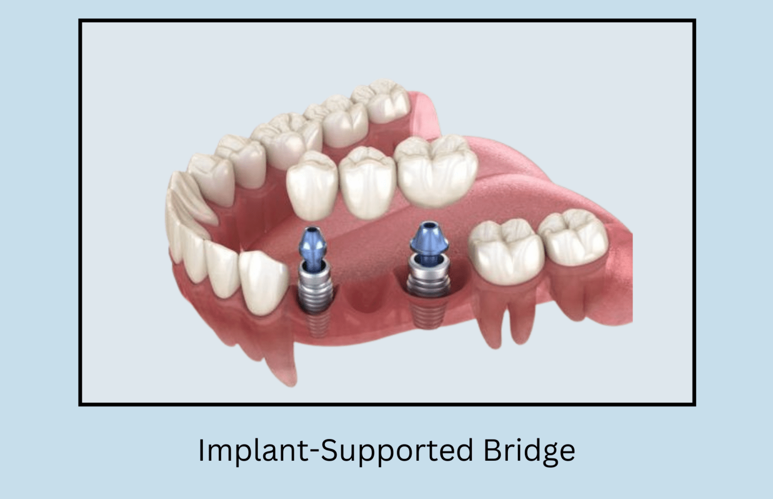 What Is Implant Supported Bridge Benefits And Technological