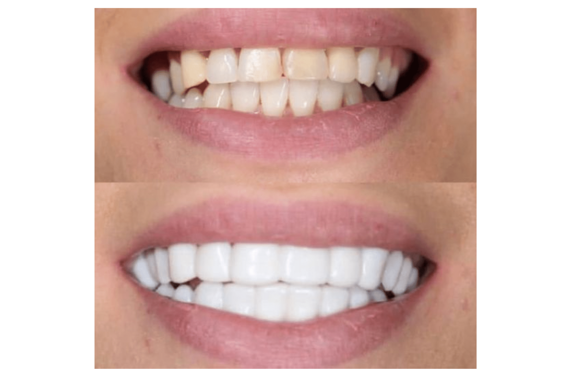 What Do Temporary Veneers Look Like? Oral Health Line