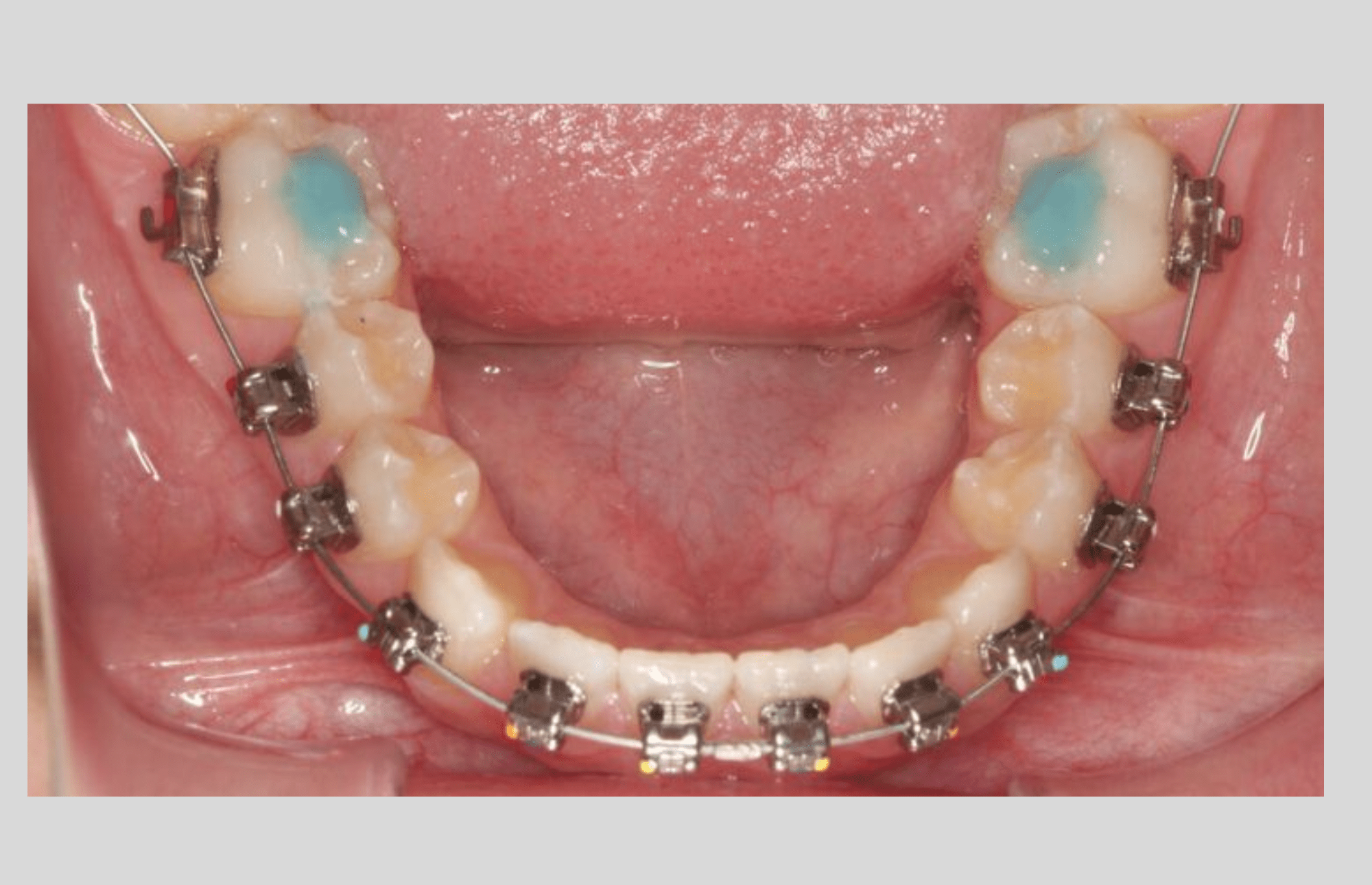 Unlocking the Mystery: Understanding Bite Turbos for Braces - Oral ...