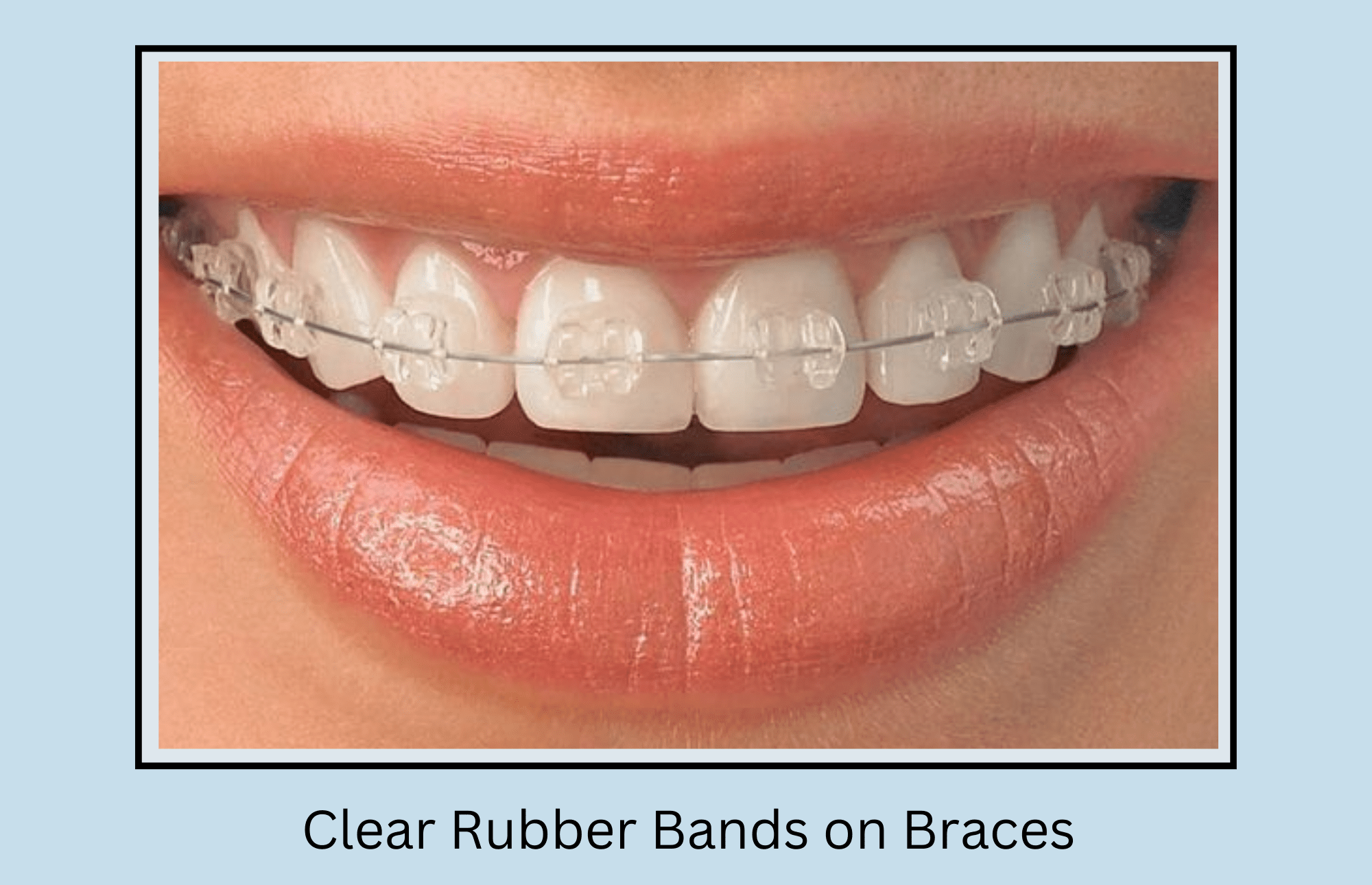 Clear sale rubber braces