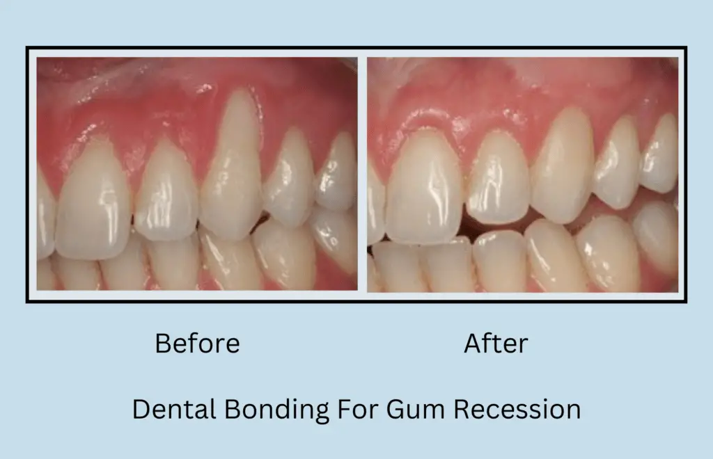 Dental Bonding For Gum Recession Procedure Benefits And Considerations Oral Health Line