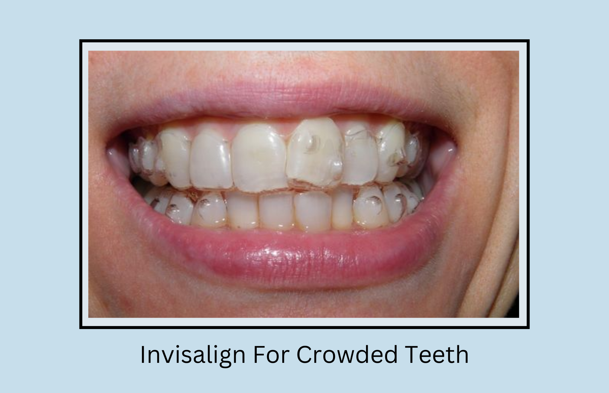Can Invisalign Fix Crowded Teeth