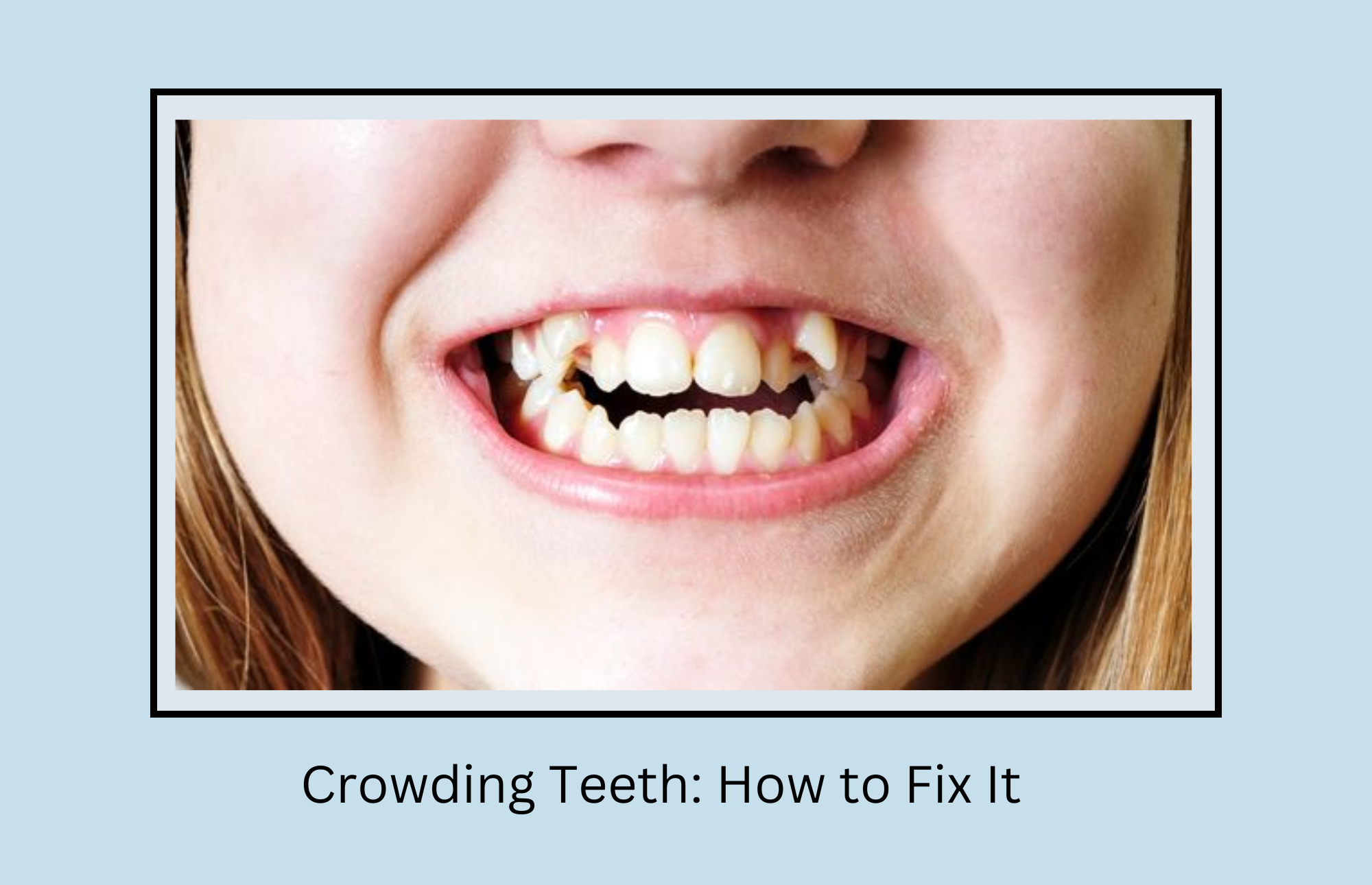Crowding Teeth