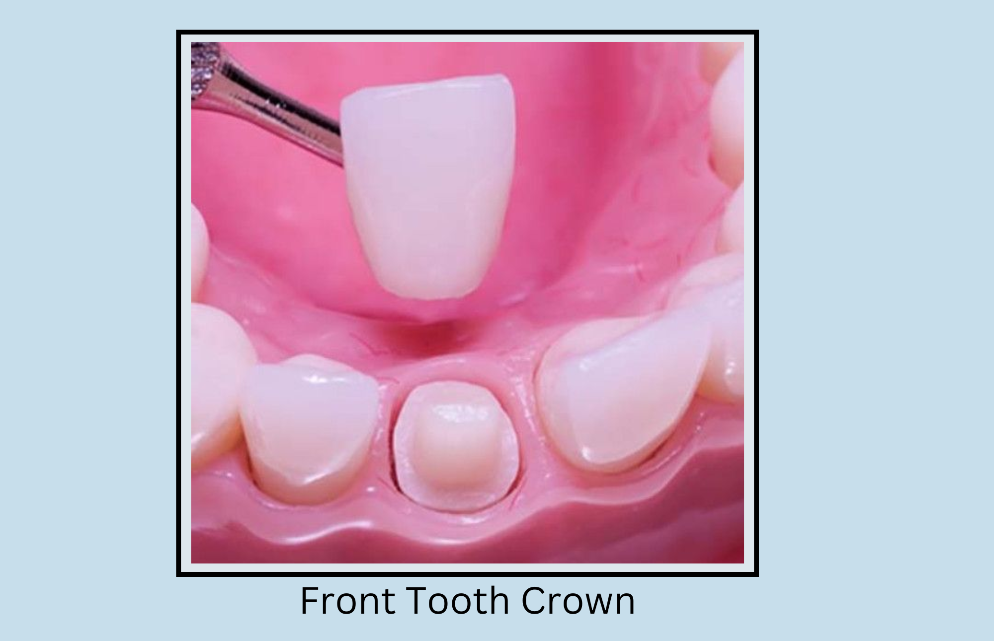 Front Tooth Crown