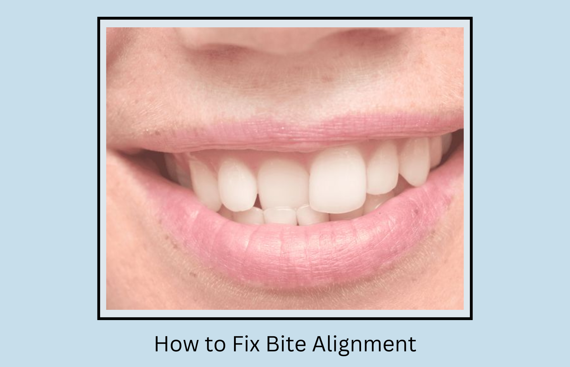 How to Fix Bite Alignment