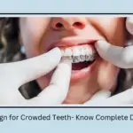 Invisalign for Crowded Teeth