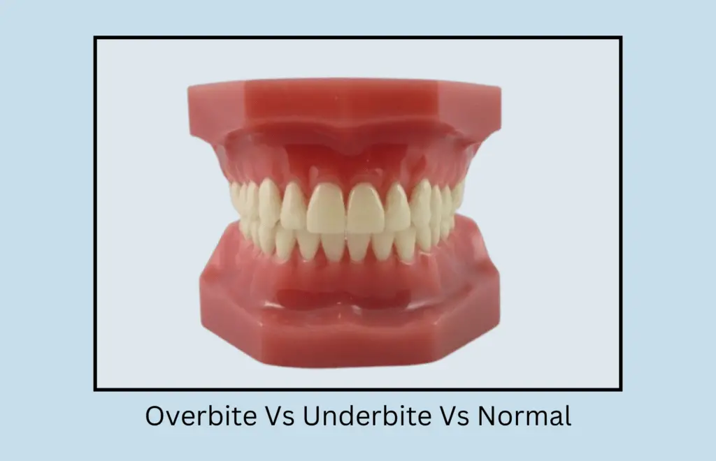 Overbite Vs Underbite Vs Normal Treatment Options Oral Health Line