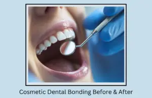 Cosmetic Dental Bonding Before After