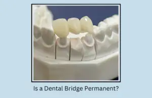 Is a Dental Bridge Permanent