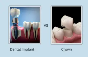 Dental Implant Vs Crown